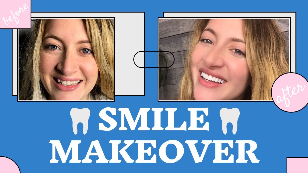 AUSTIN: I Got Porcelain Veneers at The Cosmetic Dentists of Austin!