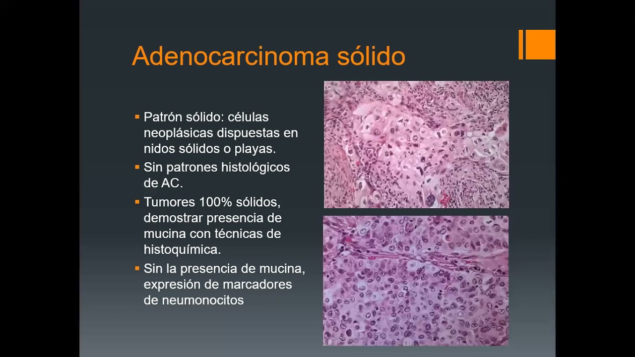 Patología neoplasica pulmonar I