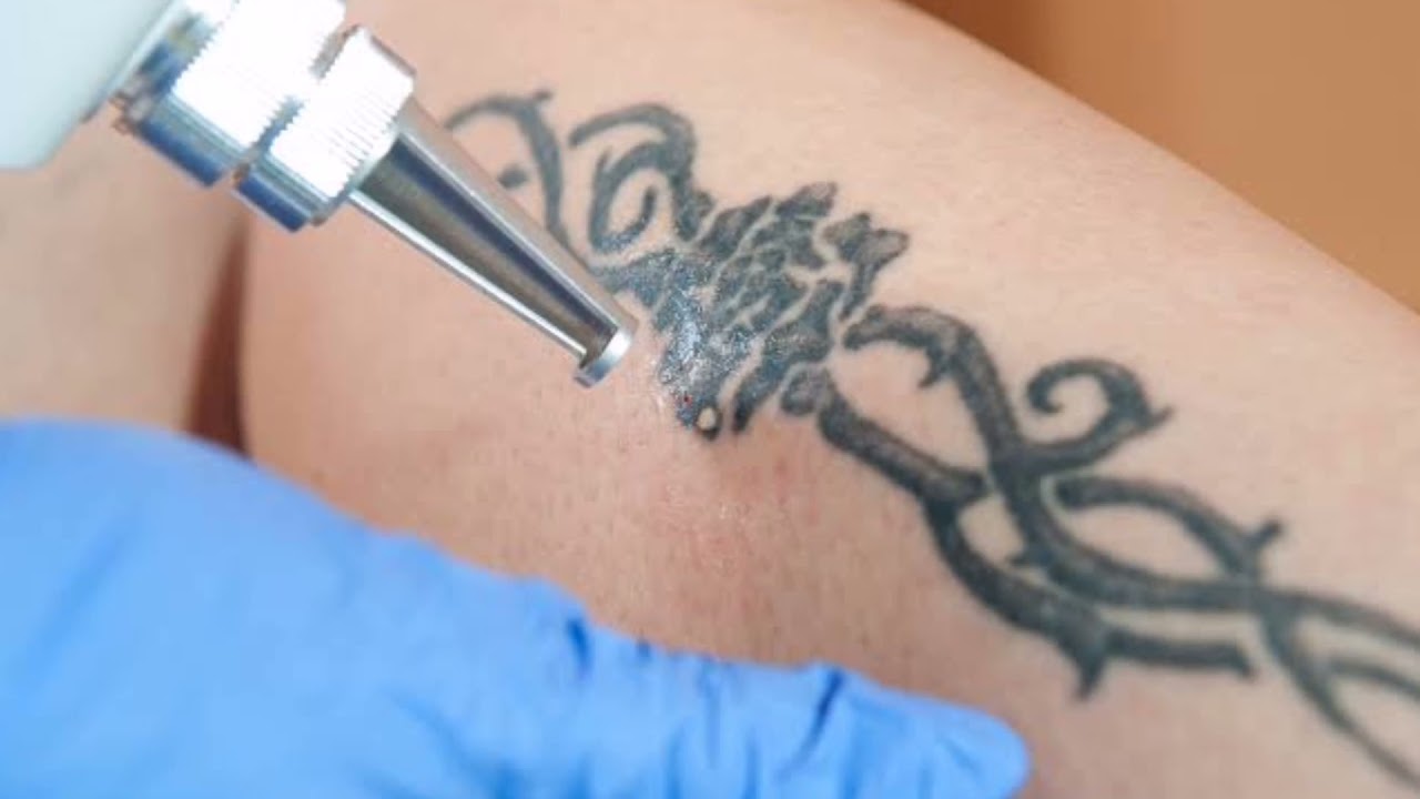 Tattoo Remove कराना होगा इतना आसान कभी सोचा ना था 