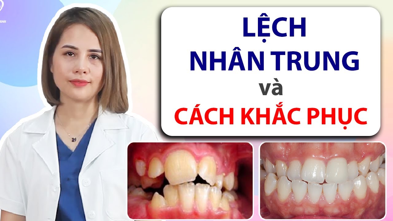Bác sỹ Thùy Anh | Cách khắc phục lệch nhân trung hiệu quả