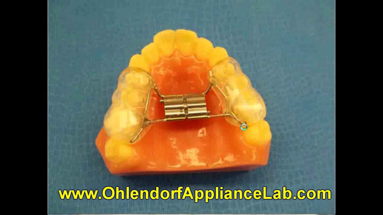 Fixed Upper Orthodontic Expanders | Fixed Upper Expander Labs | Fixed Applaince Labs