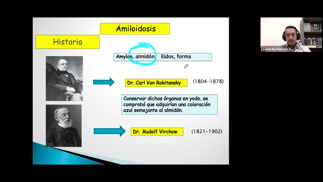 Amiloidosis