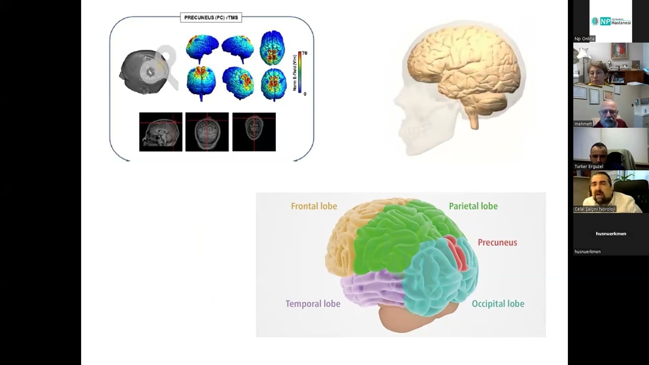MDT - Precuneus Magnetic Stimulation for Alzheimer`s Disease: A Randomized, Sham Controlled Trial