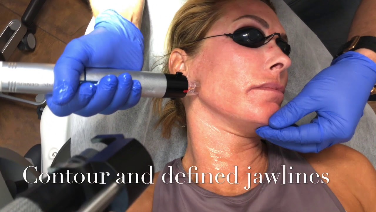Face & Neck Lift with RF - Omeed Sani MD - Sani Aesthetics