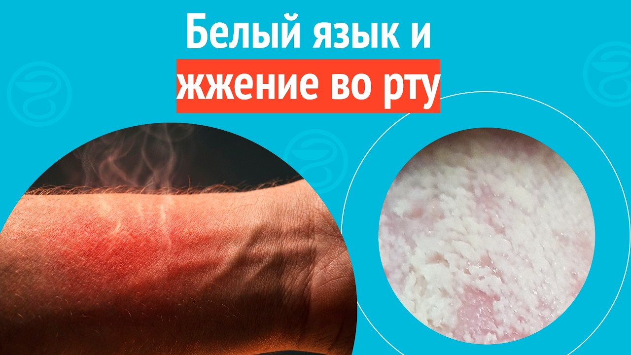 👅 Белый язык и жжение во рту. Клинический случай № 1729