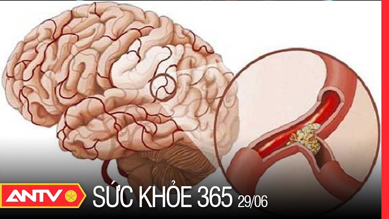 Nhồi M&aacute;u N&atilde;o V&agrave; Những Điều Cần Lưu &Yacute; | Sức khỏe 365 | ANTV