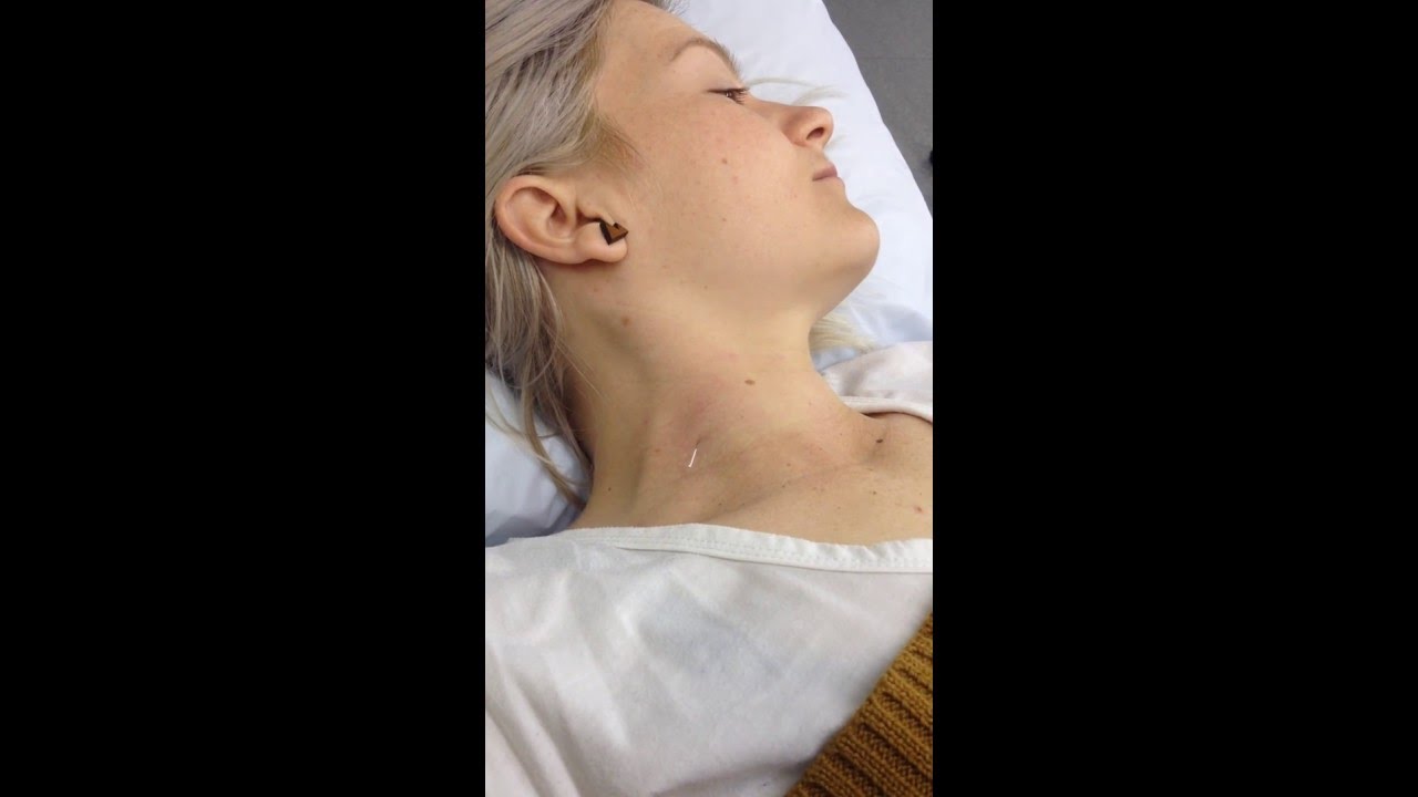Scalenes Dry Needling