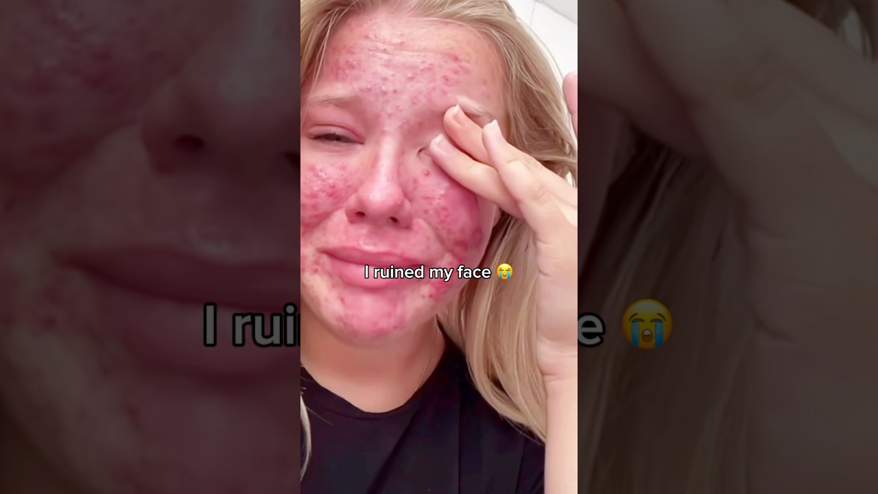 Этот ОДИН ингредиент вылечил мою кожу, когда НИЧЕГО другое не помогало! 🤯 #говяжийжир #уходзакоже...