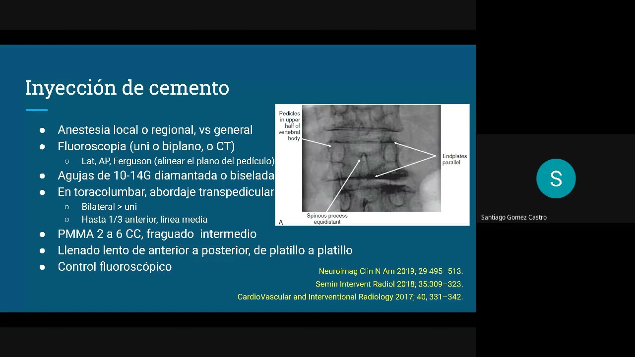 Aumentación vertebral percutánea