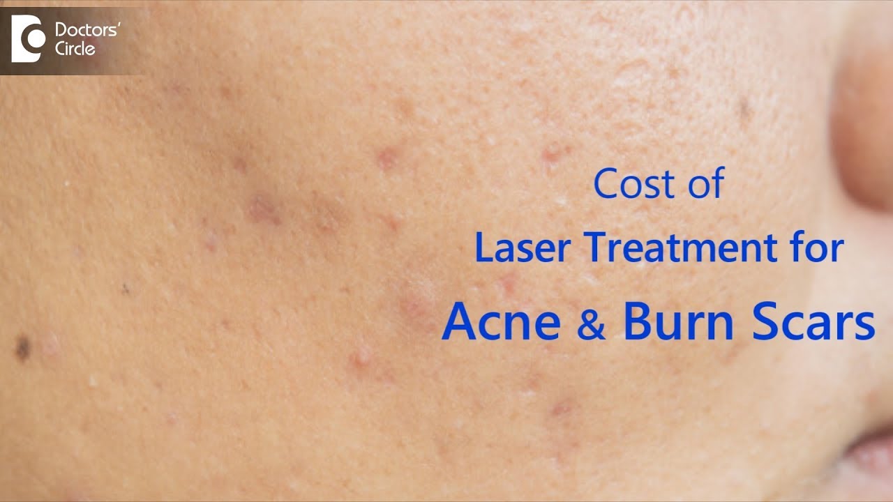 What is the cost of laser treatment for acne & burn scars? - Dr. Rasya Dixit