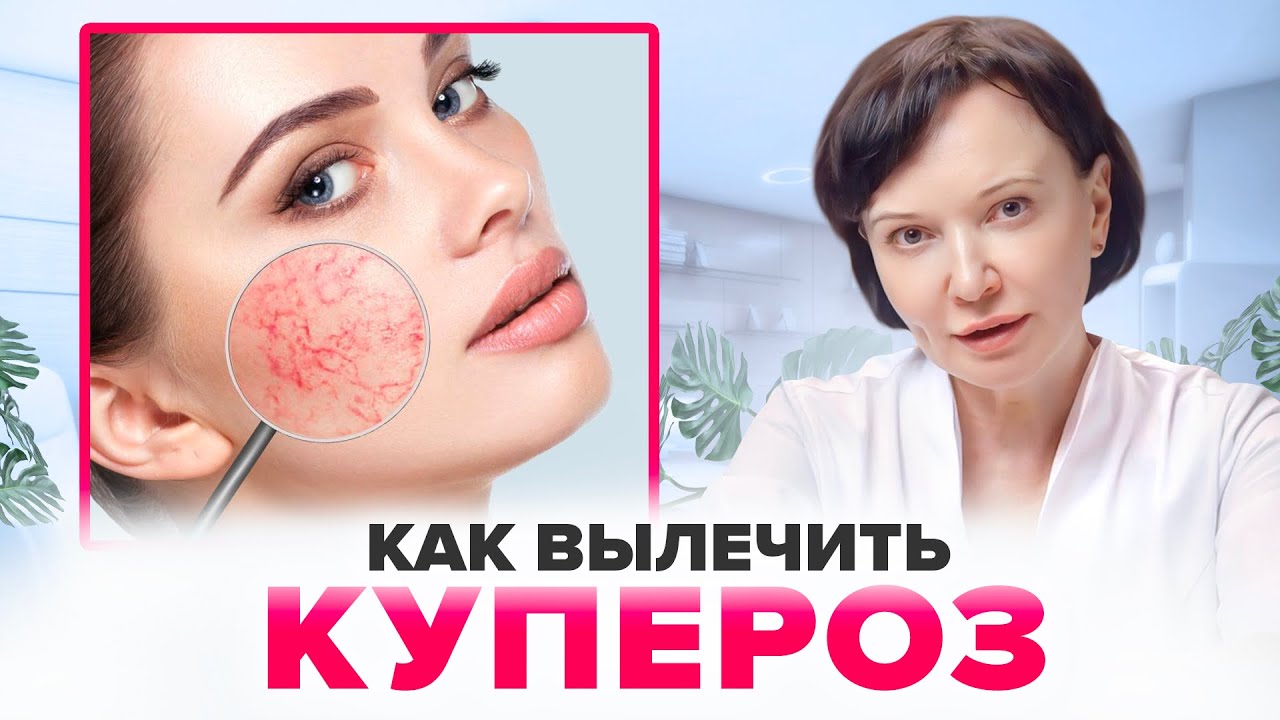 Как вылечить КУПЕРОЗ | Ирина Рахова