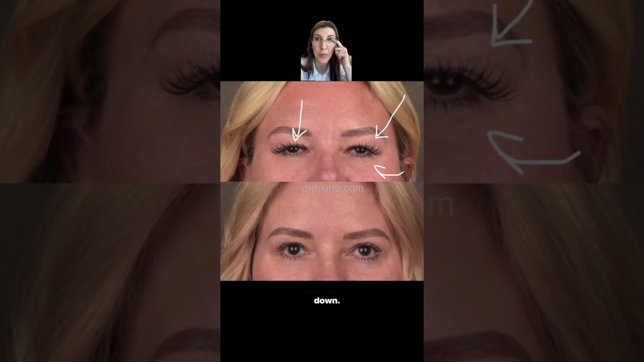 When eyelid surgery goes beyond just a little skin removal….