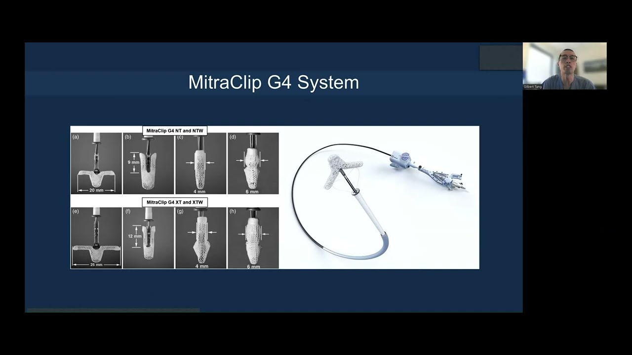 2023 CHIP India Lecture: MitraClip transcatheter edge-to-edge repair (TEER): Step by Step
