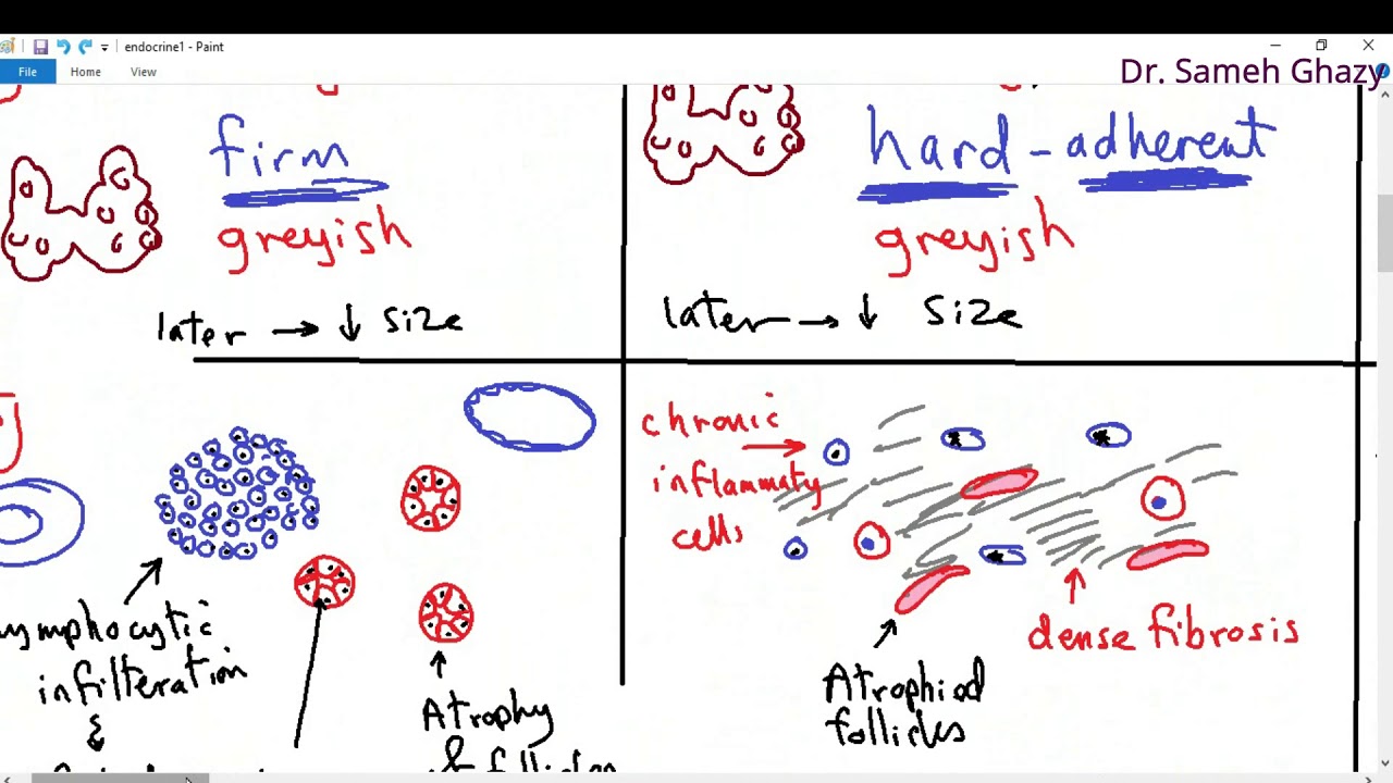 Systemic pathology 26 : Endocrine 1  ( thyroiditis )   DR.SAMEH GHAZY