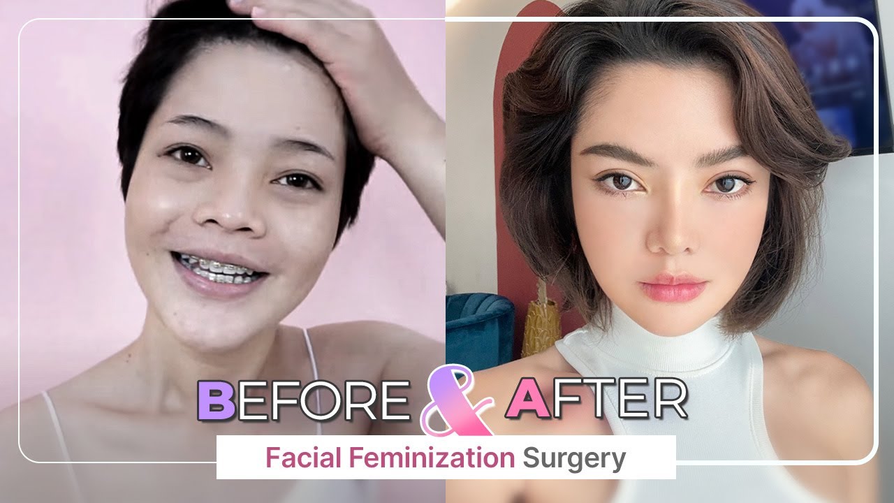 [SUB] Check out our Amazing Before and After FACIAL FEMINIZATION SURGERY (FFS) Top 5!