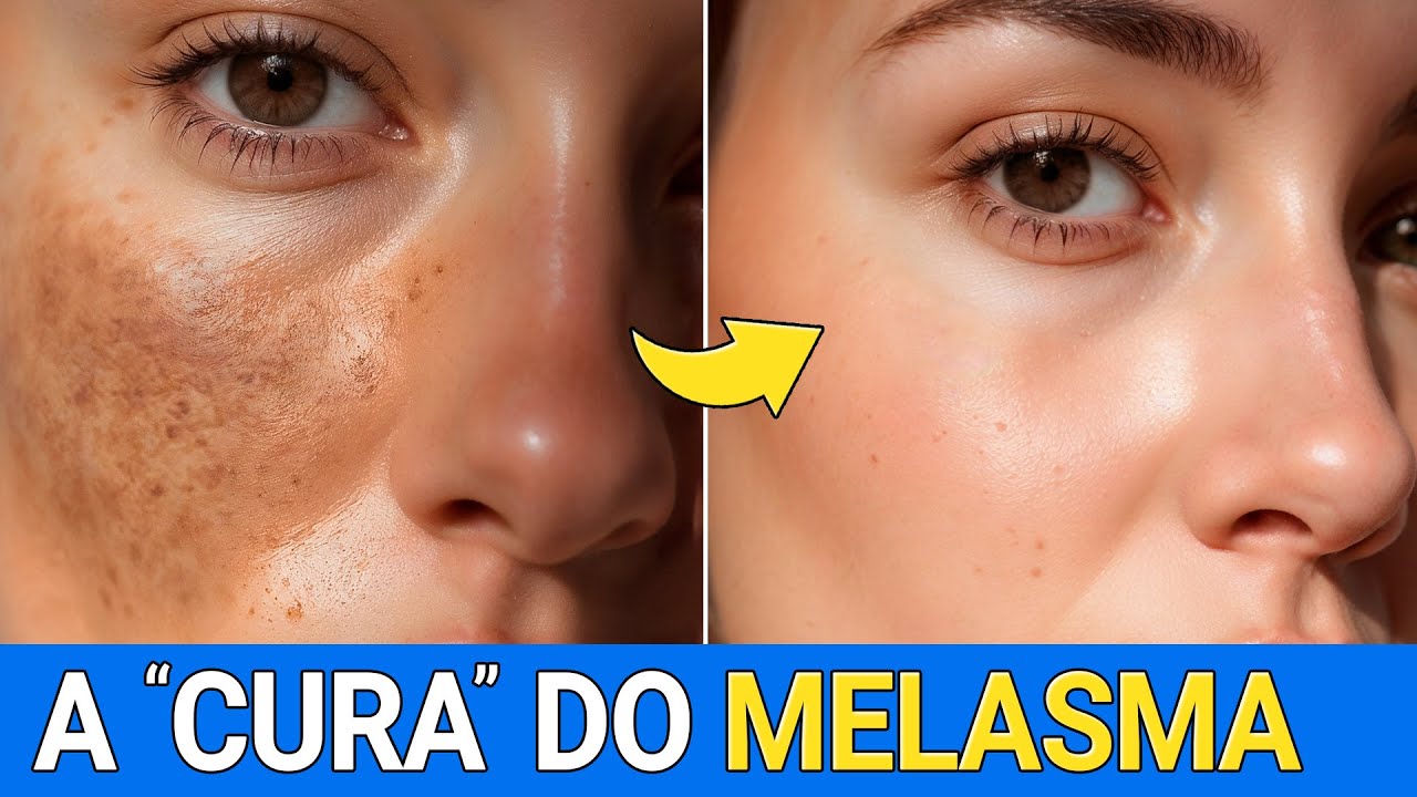Acabe com o MELASMA de Forma Natural e SEM EFEITO REBOTE!