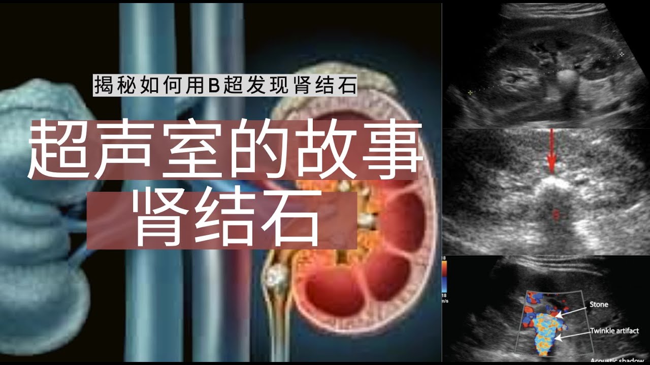 肾结石---超声室的故事【Ultrasound Room】Diagnosing Kidney Stones on Ultrasound