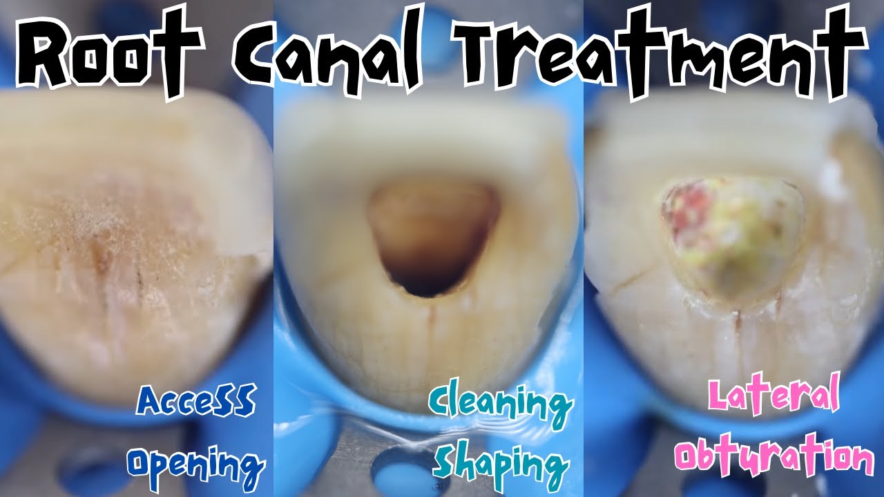 Root Canal Treatment 🔵 Maxillary Central Incisor 🟡 Step Up & Crown Down 🔴 Lateral Condensation
