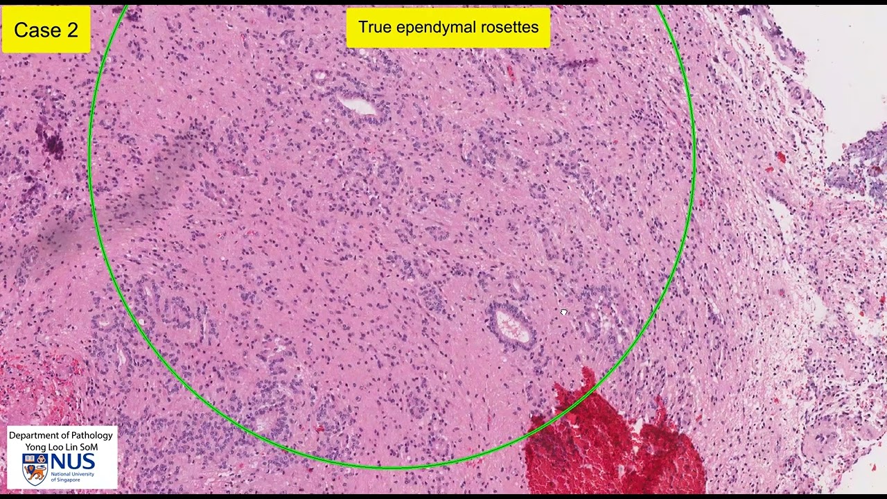 Ependymoma microscopy - Talking slide