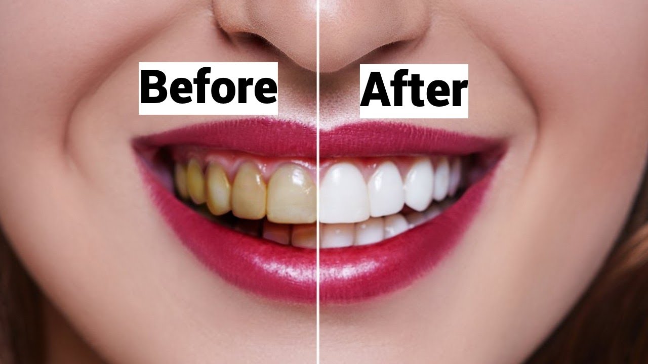 What Happens If You Stop Brushing Your Teeth || One Mission DMD