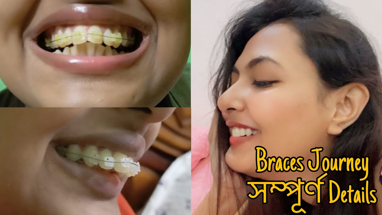 আমার Braces Journey | কত টাকা লাগে? কত দিন সময় লাগে?