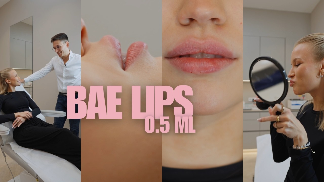 0,5 ml BAE Lips  💉 Natürlich & ohne „Schnabel“-Look