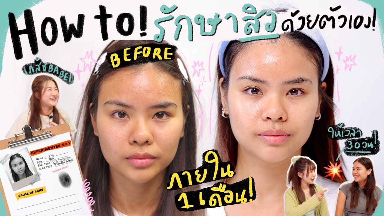 ทดลองรักษาสิวด้วยตัวเอง 30 วัน! จากผู้ประสบภัยจริง ตามคำแนะนำเภสัช! มาดูผลลัพธ์กัน 🆘✨ (peoderm)