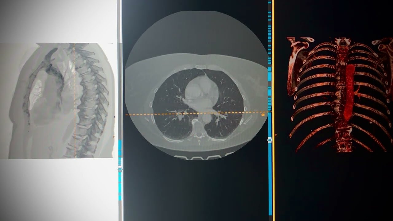 CT assessment -  osteophyte induced adjacent pulmonary atelectasis and fibrosis