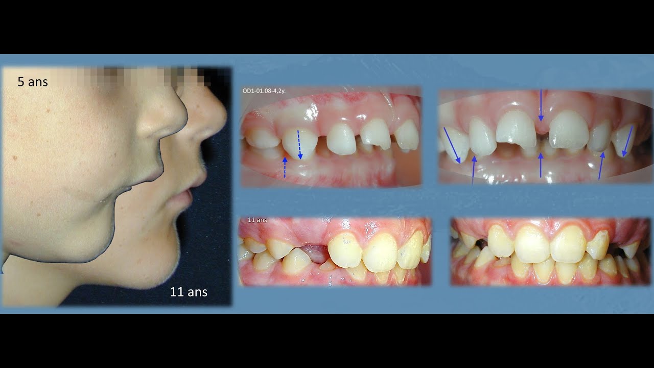 Vlog3-Engl-The Orthoglobal Concept to change the paradigm in Pediatric or very early Orthodontics.