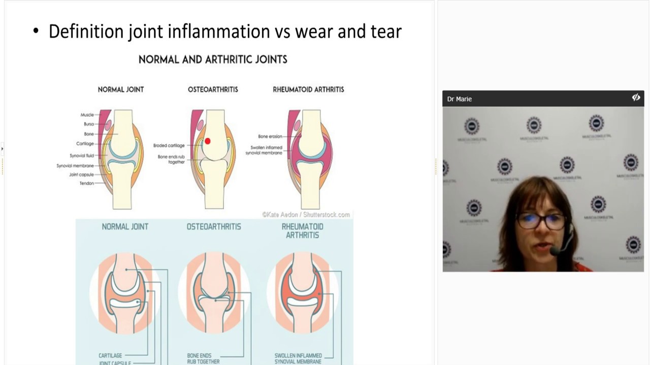 Diagnosing and managing psoriatic arthritis