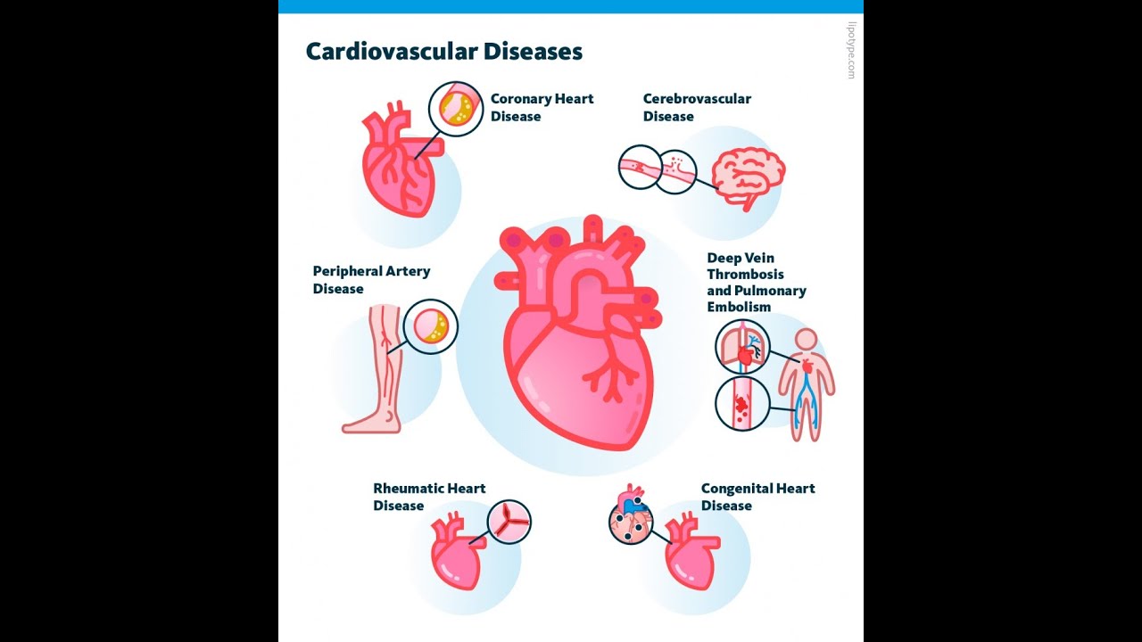 Differential Diagnosis for Coronary Artery Disease