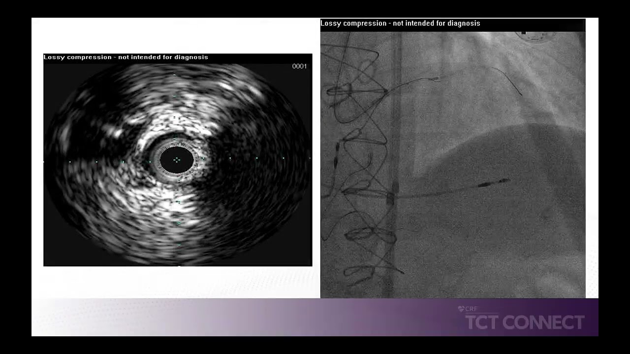 Complex CTO with Proximal Cap Ambiguity solved using IVUS Guided Puncture of the Proximal Cap