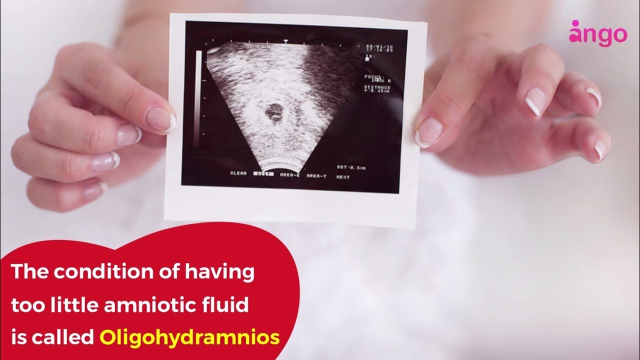 What is Oligohydramnios?