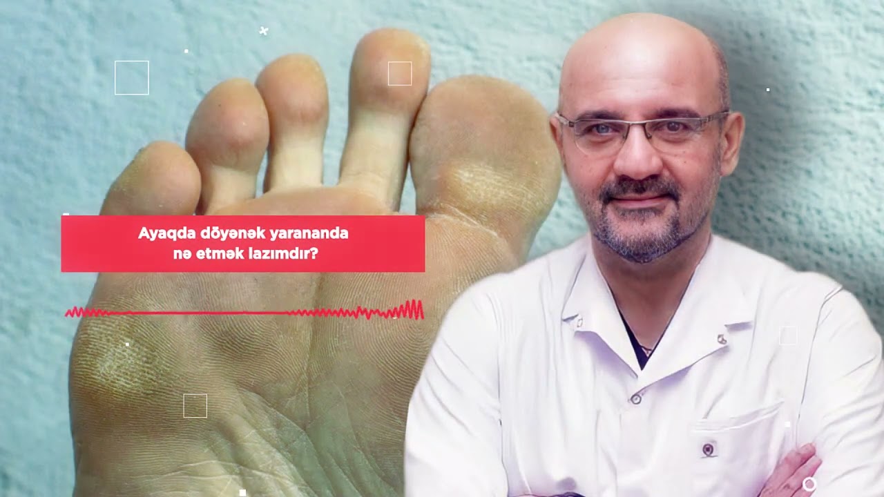 Ayaqda döyənək yaranması
