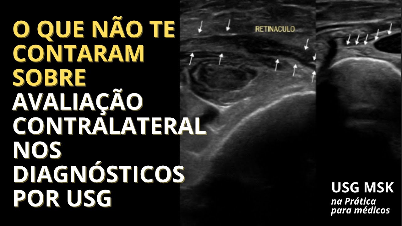 O que n&atilde;o te contaram sobre avalia&ccedil;&atilde;o contralateral nos diagn&oacute;sticos por USG
