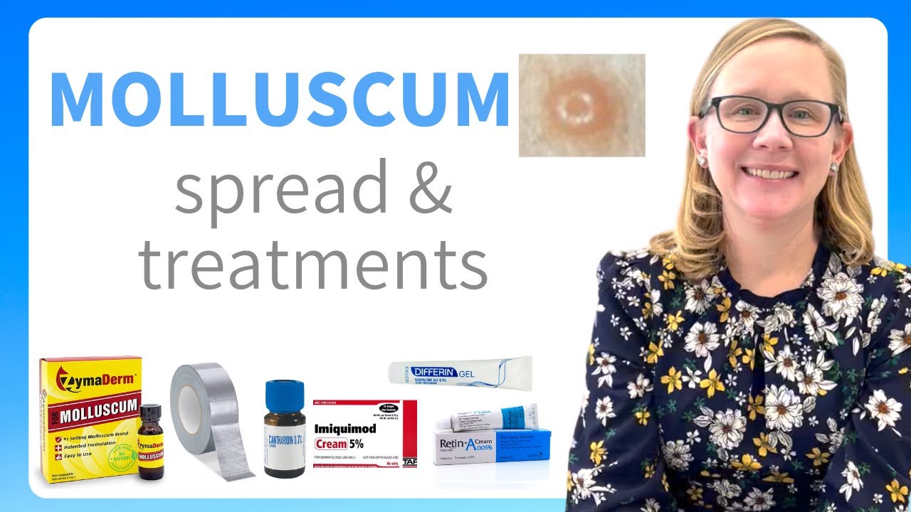 Molluscum FAQ about the spread and treatment from a pediatric dermatologist in 2022
