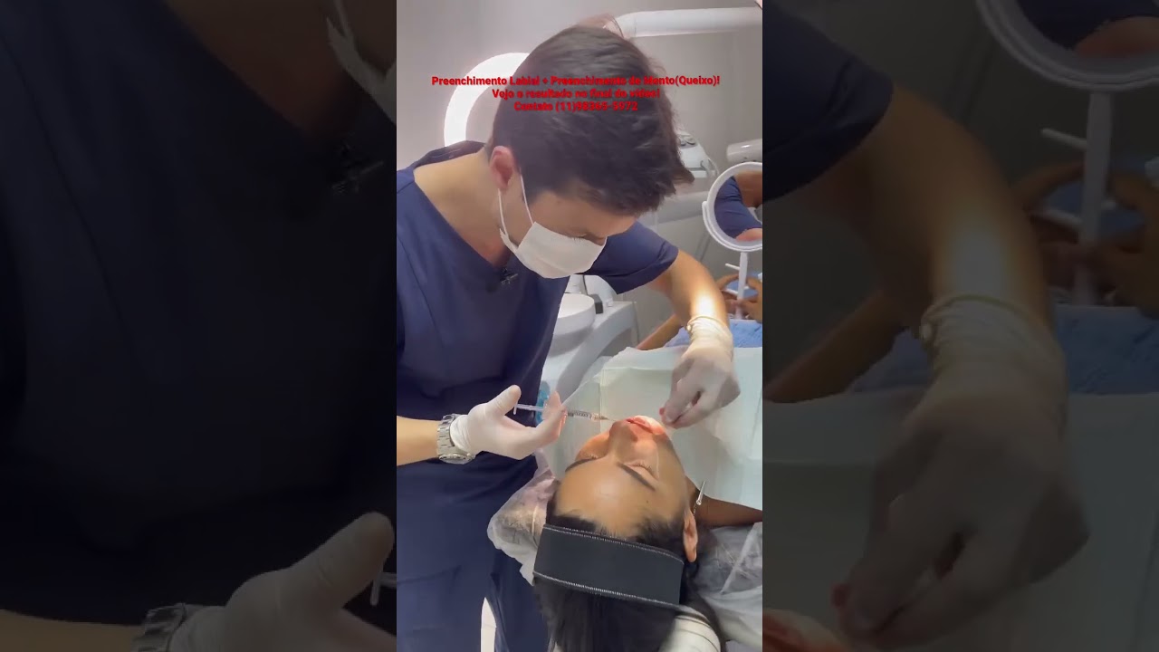 Harmoniza&ccedil;&atilde;o Orofacial. T&eacute;cnica avan&ccedil;ada de Preenchimento Labial + Preenchimento de Mento(queixo)