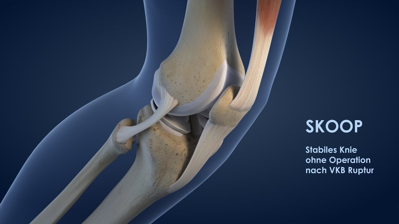 3D Animation: Kreuzbandriss Behandlung ohne Operation - SKOOP