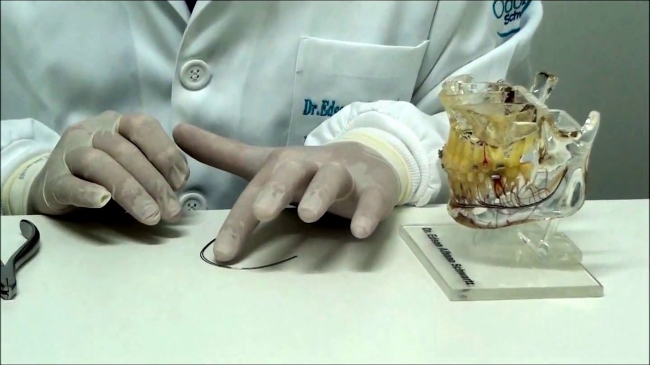 Torque progressivo posterior (passo a passo) para correção de mordida cruzada unilateral