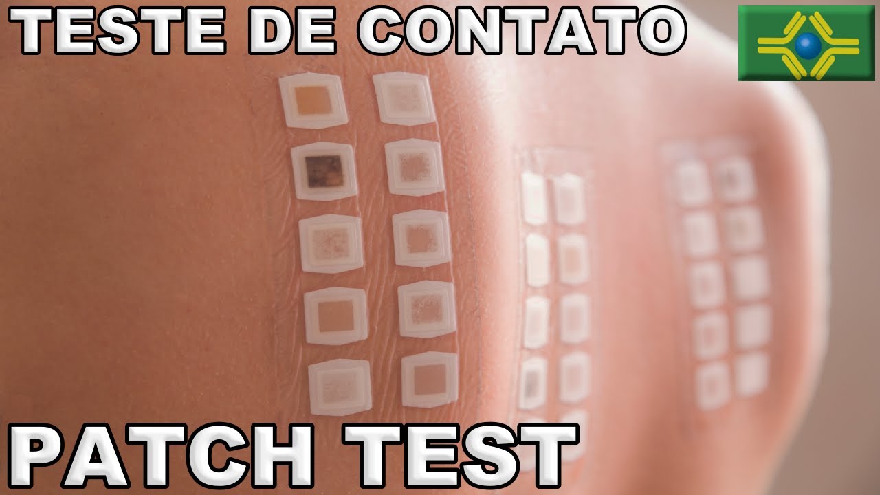 TESTE DE CONTATO | PATCH TEST | REAÇÕES ALÉRGICAS | Brasil Sem Alergia