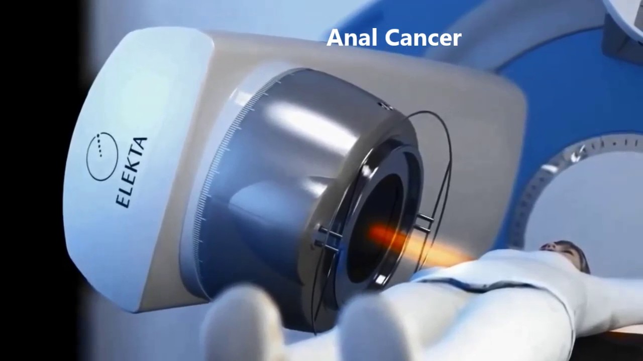 External Beam Radiotherapy for Colorectal and Anal Cancer - English