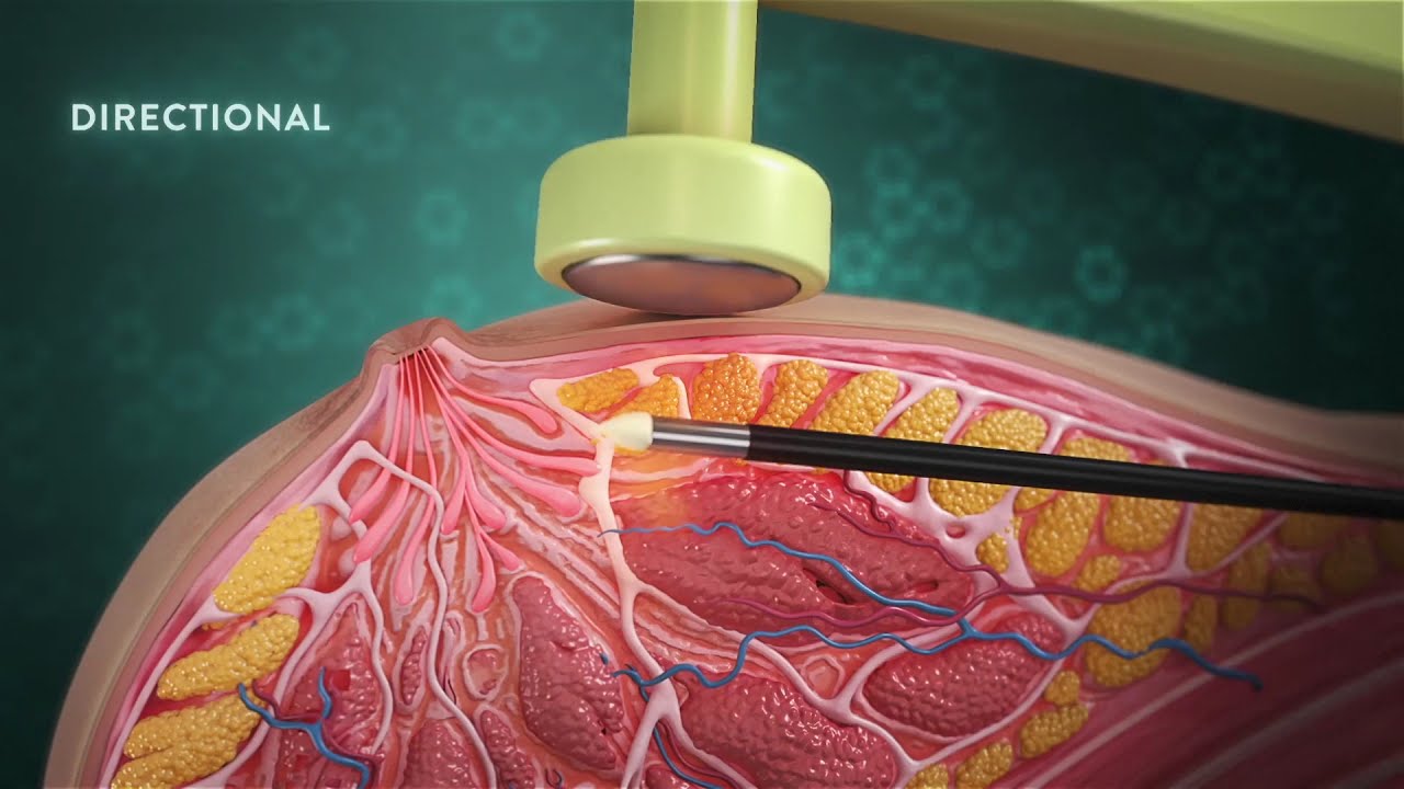 Breast Lift using BodyTite & Morpheus8 How It Works | Offered by Dr. Hooman Khorasani