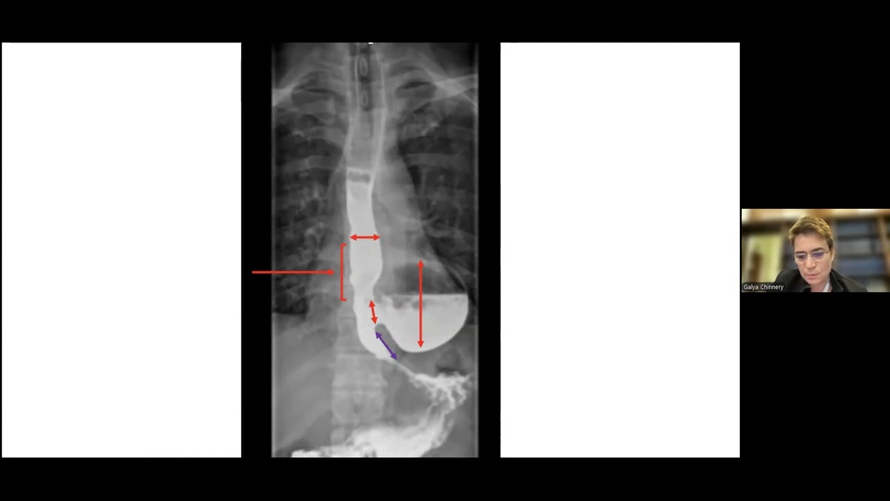 &ldquo;Investigating Oesophageal Diverticuli&rdquo; - Dr Galya Chinnery