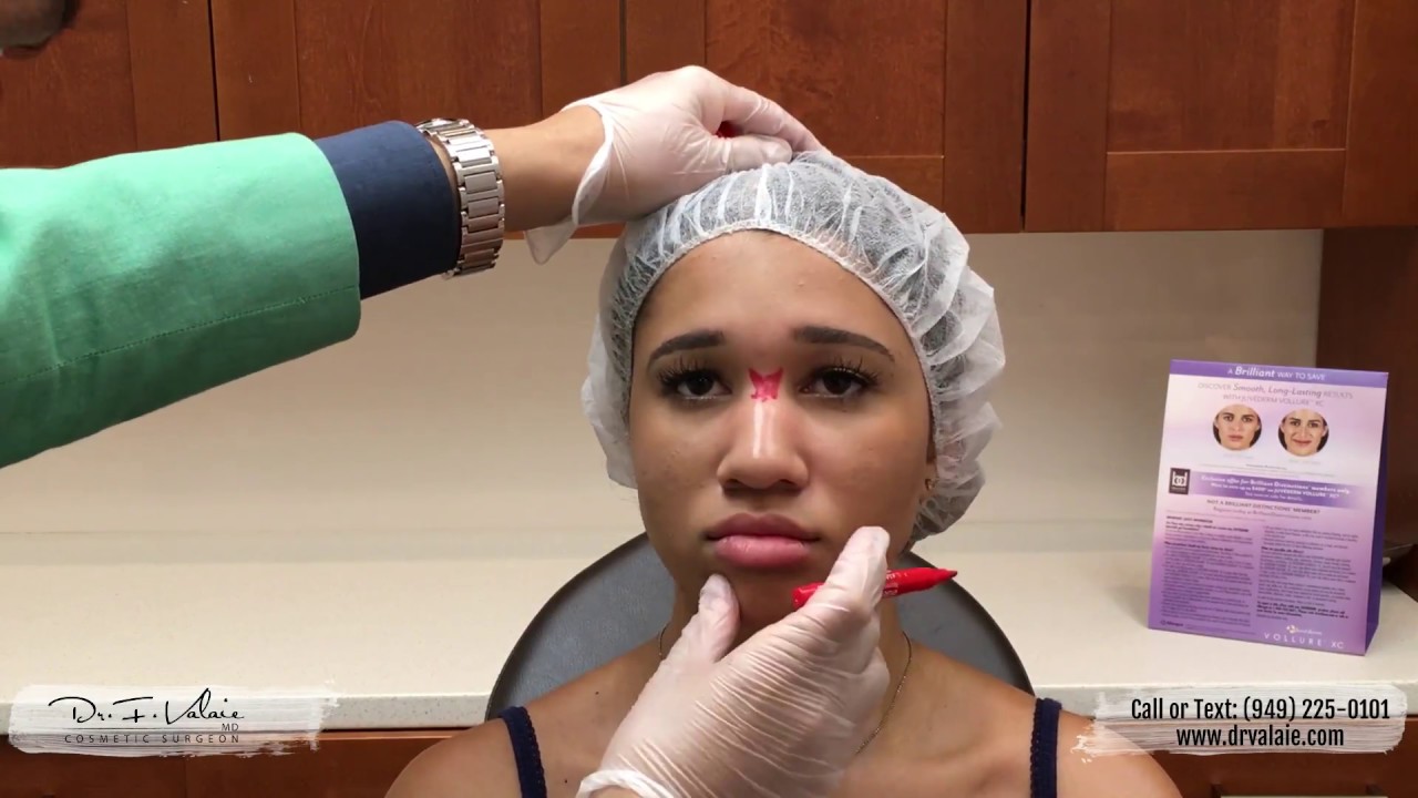 Nose Filler Injection - Dr. Valaie, MD