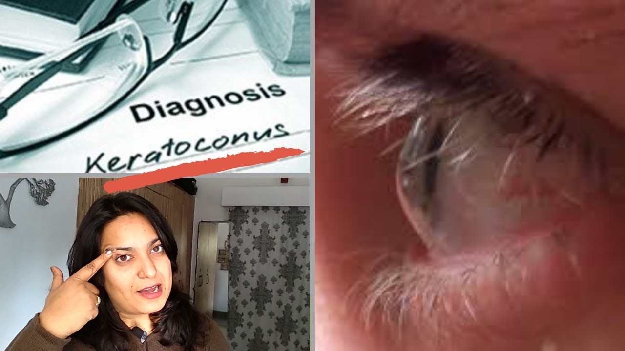 LIFE WITH KERATOCONUS  & ROSE K LENSES (RGP)