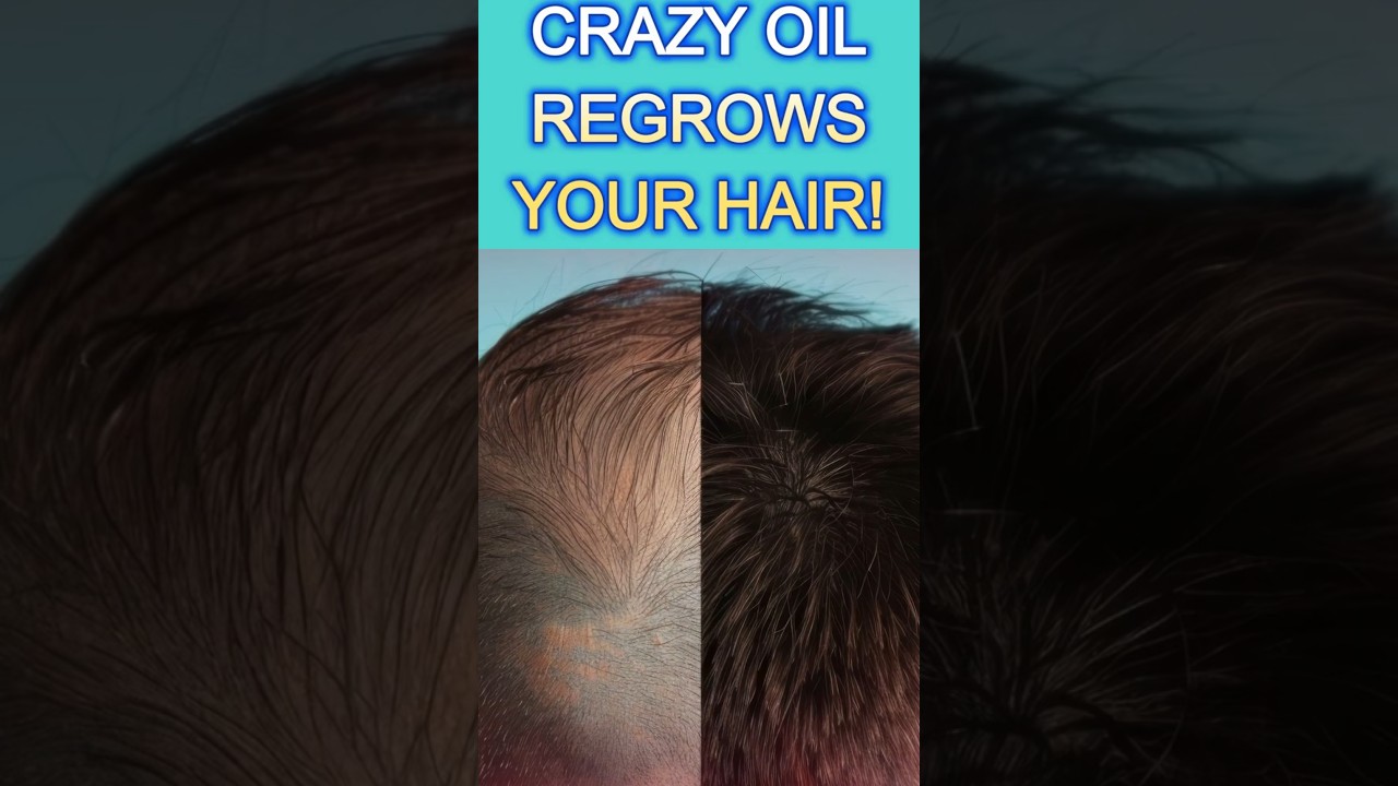 MIRACLE OIL PROVEN TO REGROW HAIR