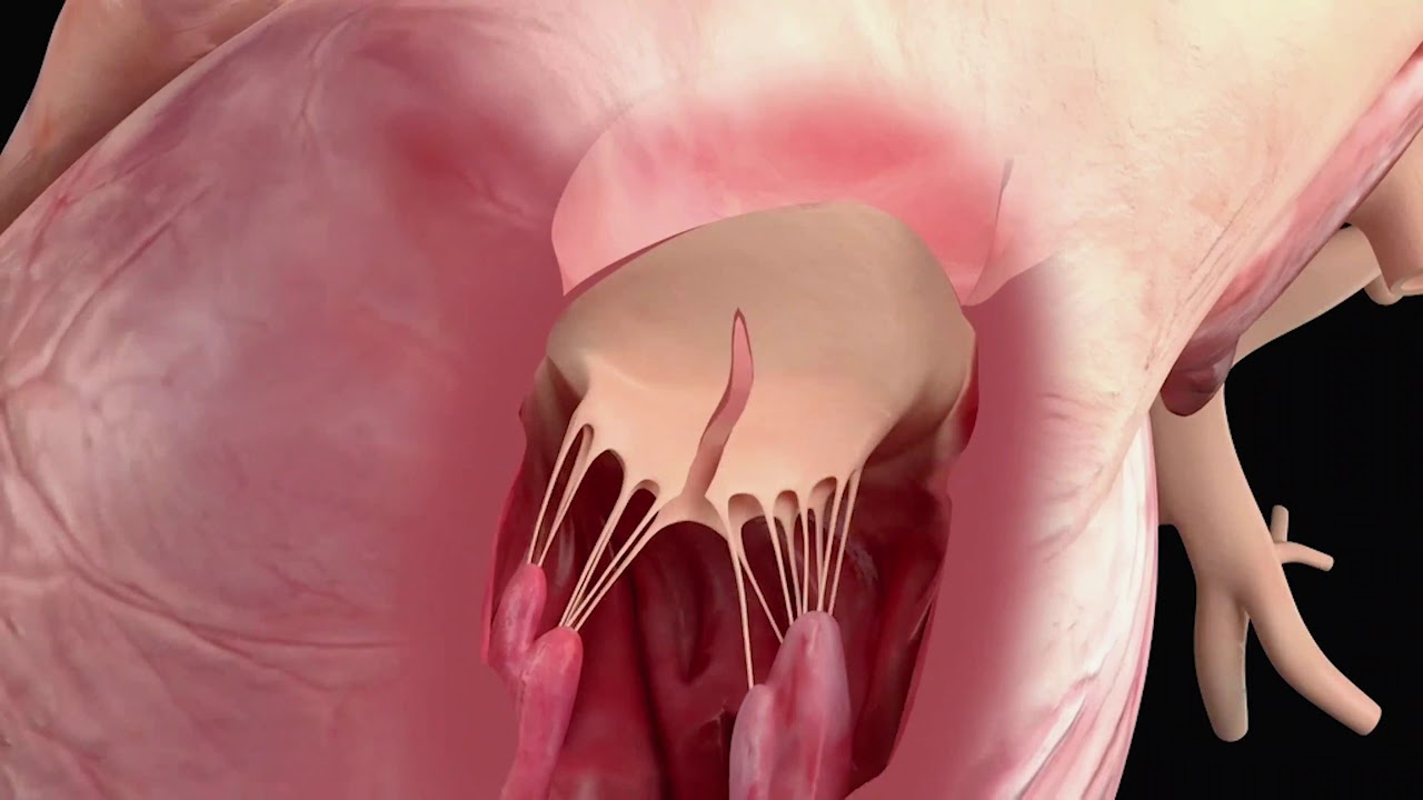 Demonstration of the LAMPOON procedure