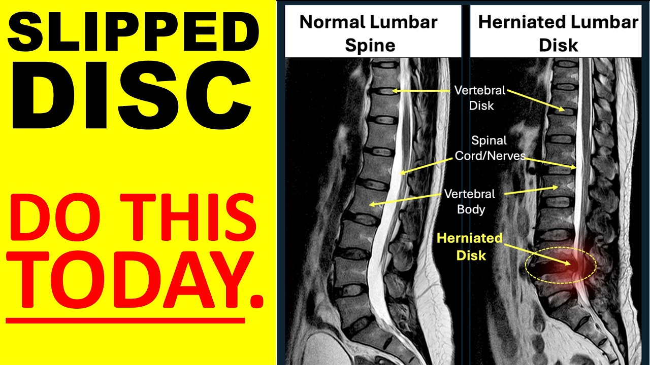 Slipped Disc - 3 signs it’s NOT serious