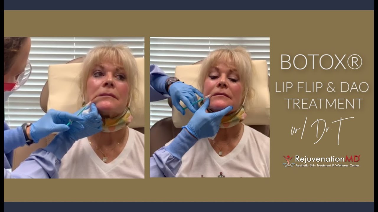 Lip Flip & DAO Treatment with Botox®