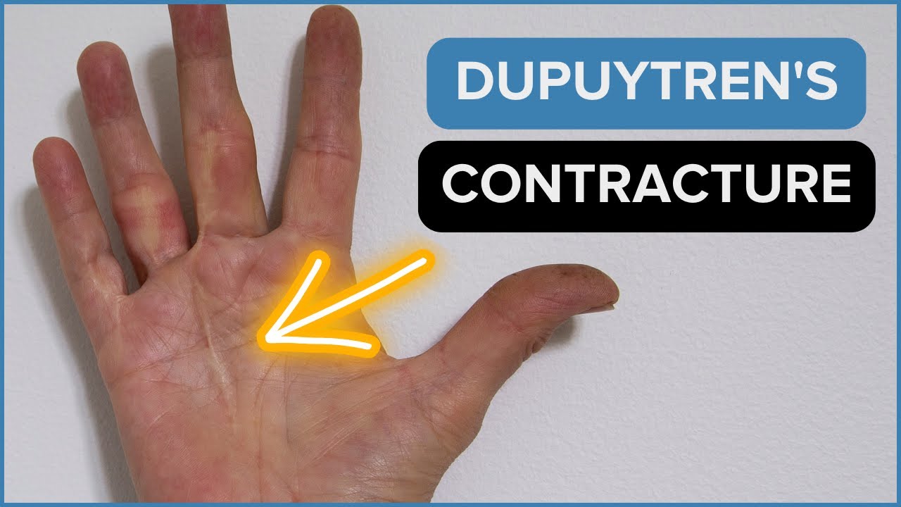 Dupuytren's Disease In Rock Climbers